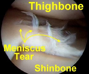 meniscus_tear.jpg