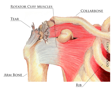 Anabolic steroids surgery recovery