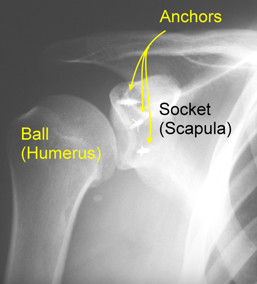 Articles and Publications Shoulder Dislocations and Instability