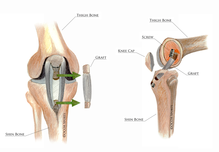 knee graft diagram