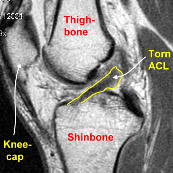 knee mri tear diagram