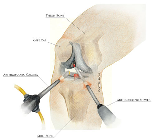 knee ortho2 diagram