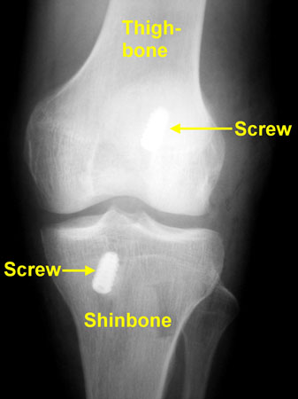 knee pin 1 diagram