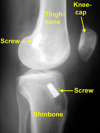 knee pin2 diagram