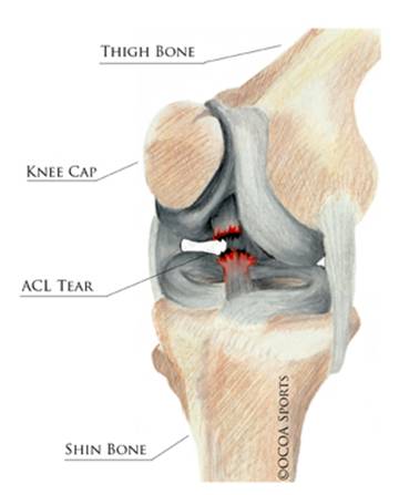 knee tear diagram