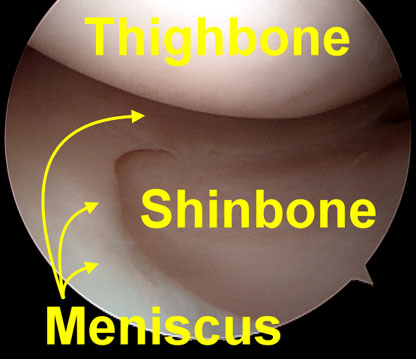 meniscus diagram