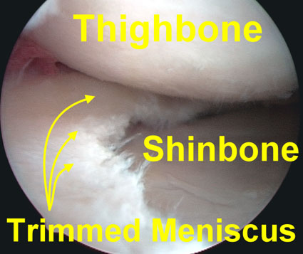 meniscus trimmed