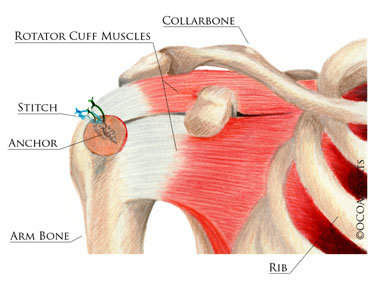 The rotator cuff is repaired back to its normal position - image with diagram named locations
