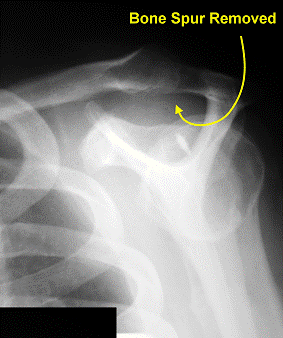 Articles and Publications | Rotator Cuff Tear