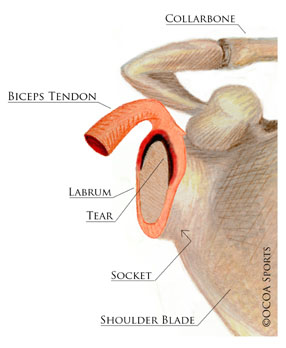 An isolated SLAP tear 1