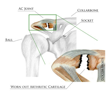 ac joint