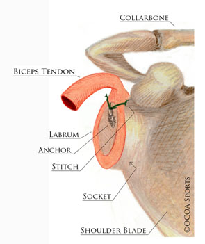 SLAP tear repaired back to its normal location