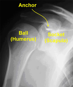 Shoulder X-Ray showing anchors