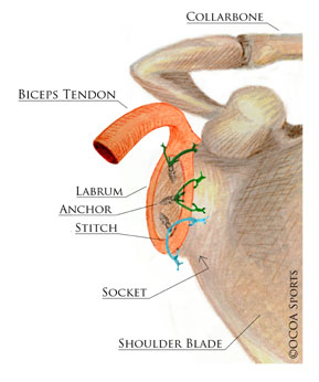 epair of a combined SLAP tear 
