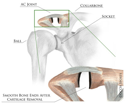 ac joint cartilage removal