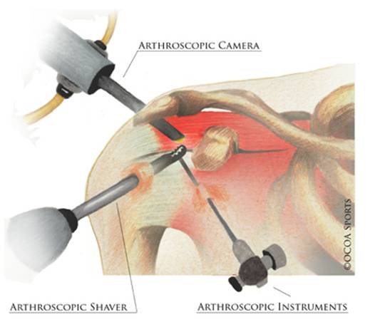 arthroscopic camera shoulder