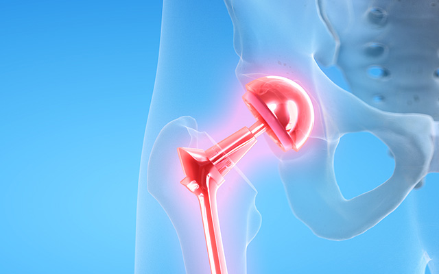 Joint Replacement Image