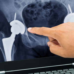 hip replacement