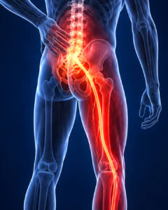 Digital illustration of a human body highlighting the lower back and leg with a red glowing path, indicating sciatic nerve pain. A hand is placed on the lower back, suggesting discomfort or pain in that area.